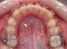 affollamento dentale, estrazioni